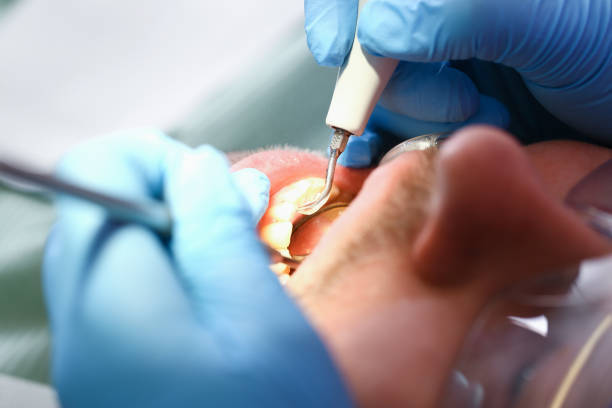 Best Emergency Treatment for Dental Infections or Abscesses in Paris, IL
